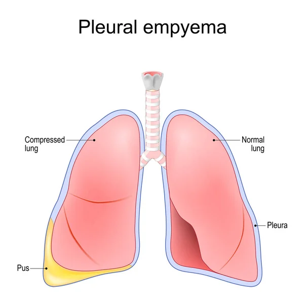 Empiema Pleural Pulmón Pulmones Normales Después Acumulación Pus Dentro Cavidad — Vector de stock