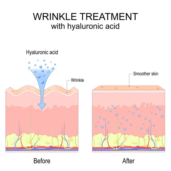 ヒアルロン酸でしわの治療 前と後の手順 目に見える結果 滑らかで若い肌 皮膚科 美容業界で使用するためのポスター ベクターイラスト — ストックベクタ