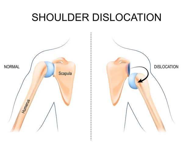 肩の脱臼 人間の骨の外傷 スポーツ傷害 または弱い肩の筋肉 人間の腕の解剖 骨や肩の関節 ベクターイラスト — ストックベクタ