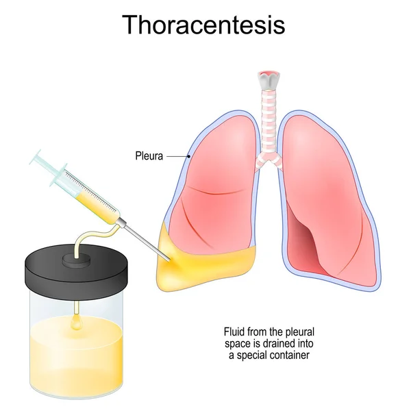 Thoracentesis Thoracocentesis Invasive Medical Procedure Remove Fluid Air Pleural Space — Stock Vector