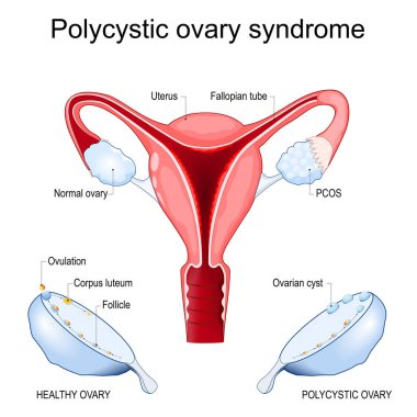 Polycystic ovary syndrome. Cross section of an Uterus with Normal ovary, and PCOS. Close-up of ovary after ovulation, with cyst, follicle, and corpus luteum. women endocrine disorder. Female reproductive system. vector illustration. clipart