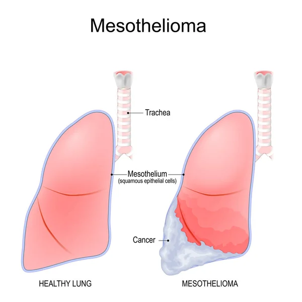 Mesotelioma Cancro Che Sviluppa Dal Sottile Strato Tessuto Polmonare Mesotelio — Vettoriale Stock