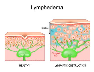 Lymphedema. Cross section of a human skin with healthy lymphatic vessel, and Swelling that caused of lymphoedema. Close-up of skin cells, and Lymph node with Disrupted flow, and and returns interstitial fluid to the bloodstream. Lymphatic obstruction clipart