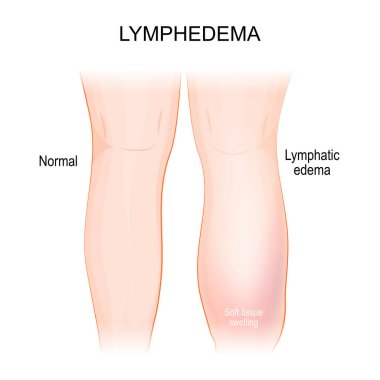 Lenf kanseri. Lenfoödem. Sağlıklı bacak ve lenf ödemi. Lenfatik sistemin neden olduğu şişmiş bacak ve ayak. İnsan vücudunun bir parçası. Vektör illüstrasyonu