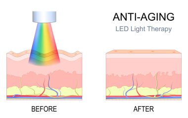 Yaşlanma karşıtı LED ışık terapisi. Ameliyat öncesi kırışıklıkları olan insan derisi ve yenilenme terapisinden sonra güzel bir ten. SPA tatil köyünde yüz terapisi. Vektör illüstrasyonu