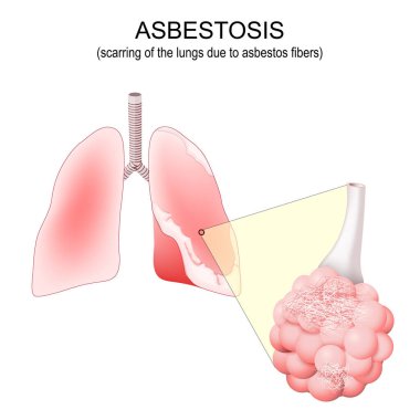 Asbestoz. Ciğerleri yaralı. Asbest kaynaklı plaklı insan akciğerleri. Asbest lifli alveolus yakın çekim. Vektör illüstrasyonu