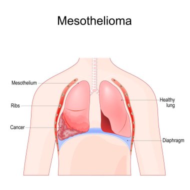 Mezotelyoma. Asbest maruz kaldıktan sonra kötü huylu akciğer tümörü. Vektör illüstrasyonu