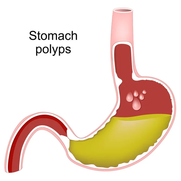 stock vector Stomach polyps. Cross section of human stomach with Gastric polyps. Hyperplasia of Gastric lining. bacterial infection caused of Helicobacter pylori. Vector illustration
