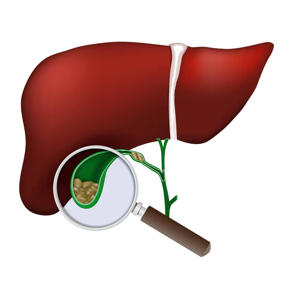 Hígado Humano Primer Plano Vesícula Biliar Lupa Examina Los Cálculos — Vector de stock