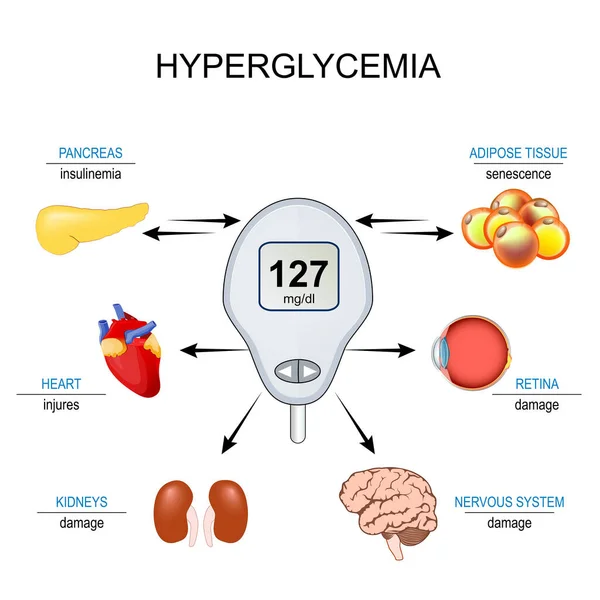 stock vector hyperglycemia. Insulin resistance. Relationship between senescence cell, High blood sugar level and complications of Diabetes mellitus. Vector illustration