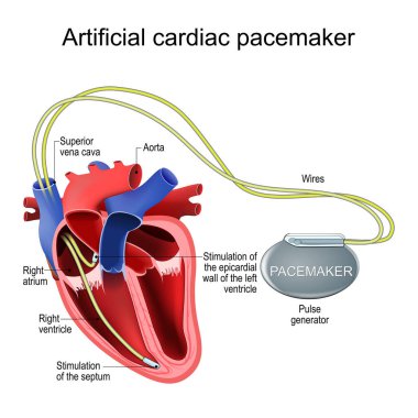 Artificial cardiac pacemaker. Heart implant. Treatment of a Bradycardia, Tachycardia, Arrhythmia. Cross section of a human heart with Pulse generator to stimulate the septum, and to pace the epicardial wall of the left ventricle. Dual-chamber pacemak clipart