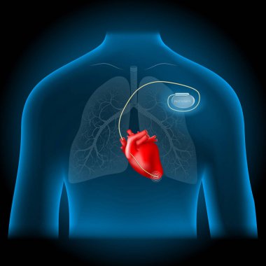 Artificial cardiac pacemaker location. realistic heart and pacemaker into blue torso. Human silhouette on dark background. vector illustration like X-ray image clipart