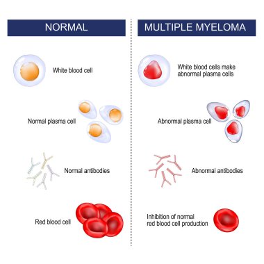 Çoklu miyelom. Normal ve Hematolojik kötülük arasındaki fark. Lökositler mutasyona uğrar ve anormal plazma hücreleri oluştururlar. Myeloma, normal kırmızı kan hücresi üretimini engelleyen sağlıklı hücrelerin büyümesini engeller.