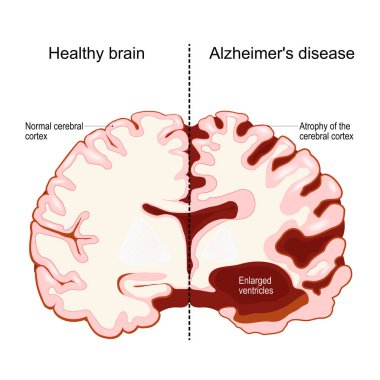 İnsan beyni, iki parça halinde: sağlıklı ve Alzheimer hastası. Nörodejeneratif bozukluk. Bunama. Hafıza kaybı ve bilişsel gerileme. Beyin yarıküresinin enine kesit. Vektör illüstrasyonu