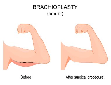 Brakhioplasti. Ameliyattan önce ve sonra. Kolunu kaldır. Ön manzara. Estetik ameliyat. Vektör illüstrasyonu