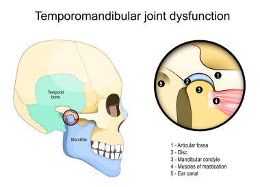 Temporomandibular eklem fonksiyon bozukluğu sendromu. Temporal kemikli bir insan kafatasının yan görüntüsü. Çene kemiğini kafatasına bağlayan mastikasyon kaslarına yakın çekim. Vektör illüstrasyonu