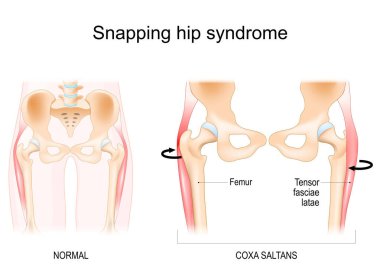 Kalça kırma sendromu. Coxa saltanatları. Iliopsoas tendiniti. Dansçı havası. İnsan kalçasının anatomisi. Vektör illüstrasyonu