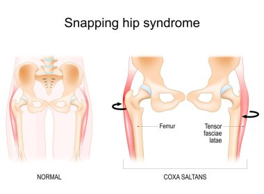 Snapping hip syndrome. Coxa saltans.  iliopsoas tendinitis. dancer's hip. Anatomy of a Human Hip. Vector illustration clipart