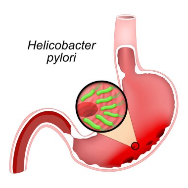 İnsan midesinde ülserle kesit. Mide ülserine yol açan Helicobacter pillori bakterisine yakın çekim. Peptik ülser. Vektör illüstrasyonu