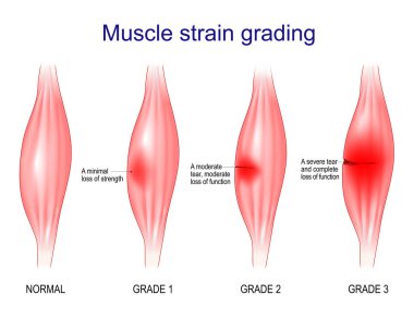 Kas gerginliği derecelendirmesi. Birinci derece asgari güç kaybı. 3. seviye ciddi bir yırtık ve fonksiyon kaybı. Vektör illüstrasyonu