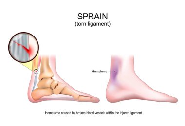 Burkulma. Ağrılı ayak bükülmesinden sonra bağları kopmuş. Yumuşak doku yaralanmasının belirtileri ve belirtileri. Kas hasarı, tendon yırtığı, bağ dokusu sorunu. Spor Travması ve Rehabilitasyon. Vektör illüstrasyonu