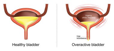 Overactive bladder. Loss of bladder control. urge incontinence. Signs and symptoms of a Bladder dysfunction. Human urinary tract. Vector illustration clipart
