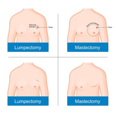 Göğüs kanseri ameliyatından önce ve sonra. Mastektomi ve Lumpectomy arasındaki fark. Cerrahi onkoloji. Vektör illüstrasyonu
