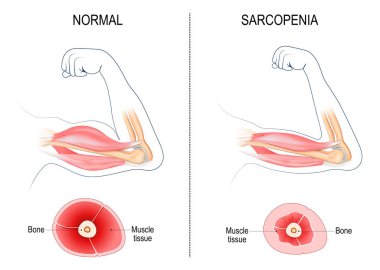 Sarcopenia. Age-related muscle atrophy. Comparison and Difference between normal arm and Muscle loss. Cross section of muscle of Young active person, and Old passive human. Vector illustration clipart