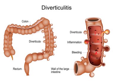 Kolon Divertiküliti. Kalın bağırsağın kesitinde kanama ve anormal kese iltihabı ya da Divertiküla var. Gastrointestinal hastalık. İnsana ait kalın bağırsak. Sindirim bozuklukları. Vektör illüstrasyonu