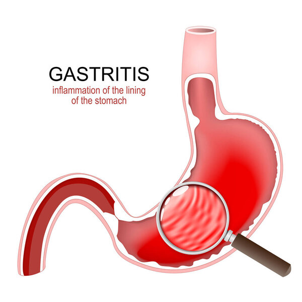 Gastritis. Stomach Inflammation. Gastrointestinal Disorders. Cross section of a human stomach and inflammation of the lining of the stomach under Magnifying glass. Vector illustration