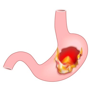 Mide ekşimesi. Ateşli insan midesi. Piroz, kardiyoloji veya asit hazımsızlığı. Midede yanma hissi var. Gastroözofagus reflü hastalığı GERD. Vektör illüstrasyonu