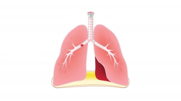 Inflamação Pulmonar Doença Infecciosa Como Pneumonia Covid Tuberculose Gripe Animação — Vídeo de Stock