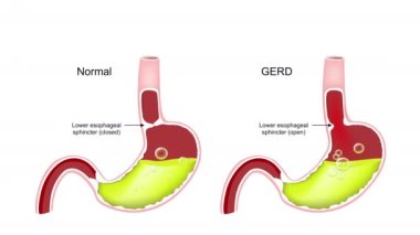 Gastroözofagus reflü hastalığı. GERD. İnsan midesinde enine kesit. Asit reflü ile normal iç organ ve mide. 2d canlandırma