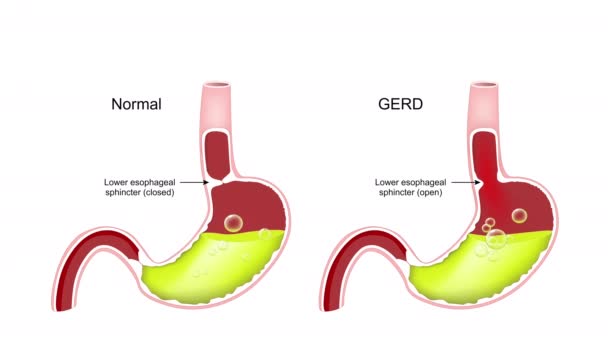 Гастроэзофагеальная Рефлюксная Болезнь Gerd Поперечное Сечение Человеческого Желудка Нормальный Внутренний Стоковое Видео