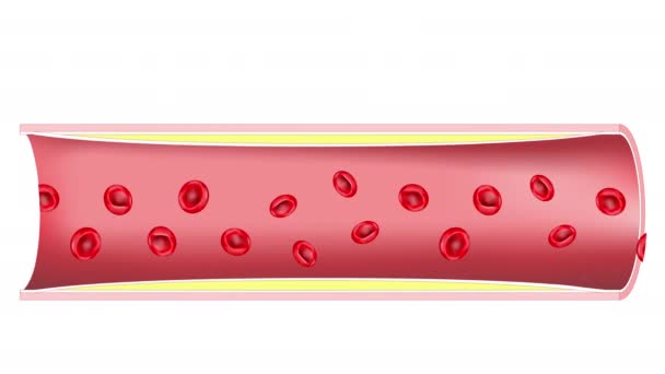 Ateroscleroza Cheag Sânge Formarea Plăcilor Placi Ateromatoase Artere Nesănătoase Dezvoltarea Videoclip de stoc