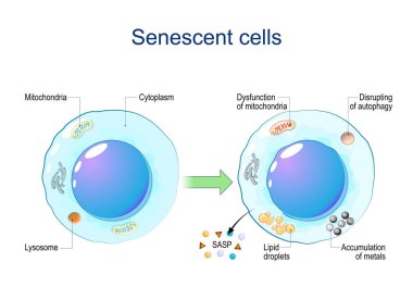 Senescent cells. Cellular senescence from Dysfunction of mitochondria, accumulation of metals, Disrupting of autophagy, Lipid droplets to release of Senescence-associated secretory phenotype SASP and chronic inflammation. DNA damage response. Aging c clipart