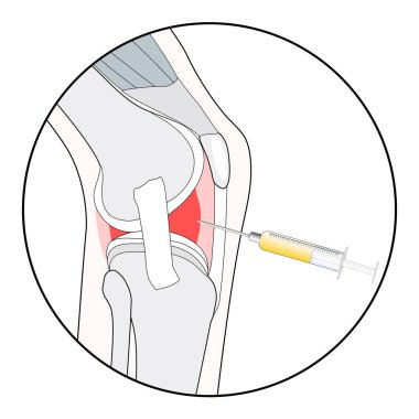 Diz enjeksiyonu. Web tasarımı için stilize pictogram veya prp biyoteknoloji, Hyaluronic asit enjeksiyonu veya osteoartrit tedavisi için tıbbi prosedür hakkında mobil uygulama. Yenilenme ilacı. Düz çizgi sembolü. eklem ve şırınganın siyah çizgi simgesi. 