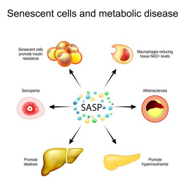 Yaşlıca hücreler ve metabolik hastalıklar. Yaşlılıkla ilişkili gizli fenotip SASP. Senesans hücreleri insülin direnci, karaciğer steatozu, kas atrofisi ve sarkopeniyi, pankreasta hiperinsülin ve atherosklerozu teşvik eder. Yaşlanma süreci ve Ch