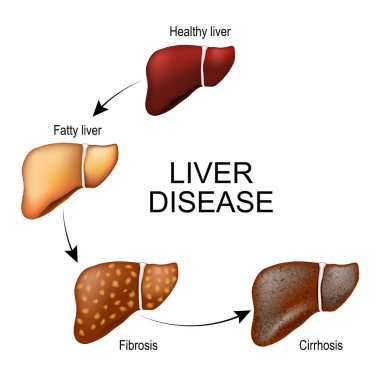 Karaciğer hastalığı. İnsan iç organının dokusu sağlıklı ve yağlı karaciğerden fibroz ve siroza dönüşüyor. Karaciğer hasarı aşamaları. Vektör illüstrasyonu