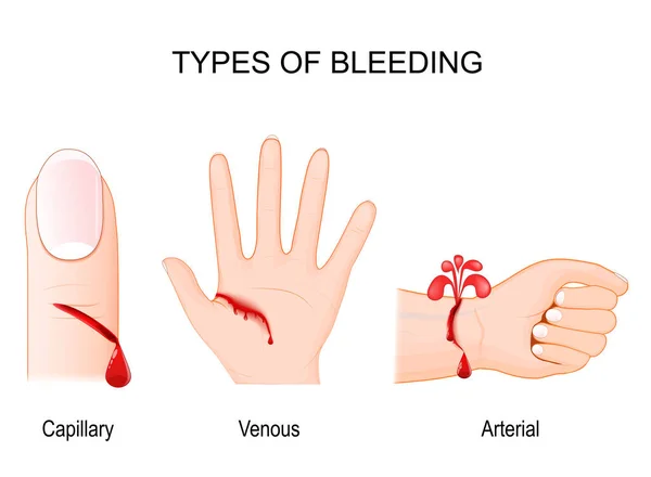 Vérzés Típusai Kapilláris Vérzéses Seb Ujján Pálma Vénás Vérveszteséggel Emberi Stock Illusztrációk