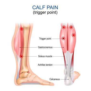 Baldır ağrısı. Tetikleme noktası. Gastrocnemius, Soleus kas, Achilles tendon ve Calcaneus. Miyofasyal ağrı sendromu. İnsan vücudu anatomisi. Vektör illüstrasyonu
