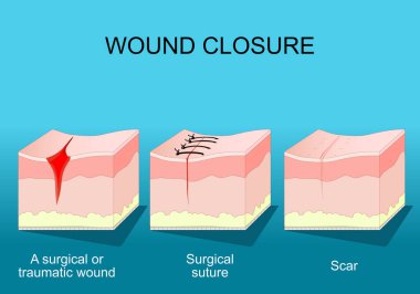 Wound healing. Skin before and after Wound Closure. From surgical or traumatic wound to suture and scar. A fibrous tissue replaces normal skin after an injury healing process. clipart