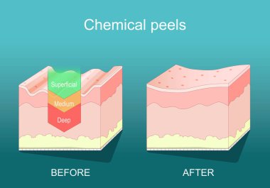 Kimyasal kabuk. Güzellik estetiği. Derin, orta, yüzeysel kabuk. Deri yenilenmesi için dermatolojik prosedür. Deri dökülmesi. İnsan derisinin çapraz kesimi. izometrik düz vektör çizimi
