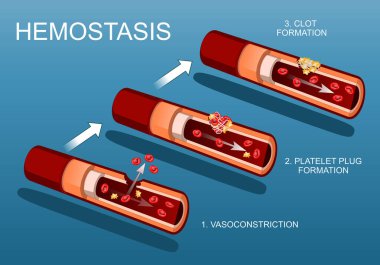 Hemostasis ve yaralar iyileşiyor. Pıhtılaşma. Vazokonstrüksiyondan trombosit dolgusu oluşumuna temel adımlar. Atardamarın kesiti. Kan damarı yaralanması ve iltihap. Kan pıhtılaşması. Kan damarı onarımı. Vektör illüstrasyonu