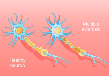 Multiple sclerosis. Autoimmune disease. Normal neuron and a neuron with a damaged myelin sheath. Nerve damage. Isometric Vector. Flat illustration clipart