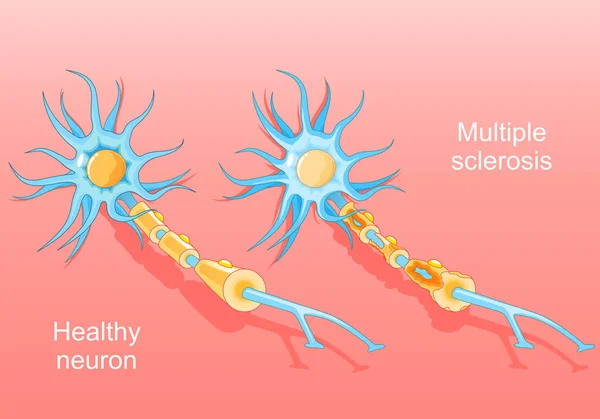 Множественный Склероз Аутоиммунное Заболевание Нормальный Нейрон Нейрон Поврежденной Миелиновой Оболочкой — стоковый вектор