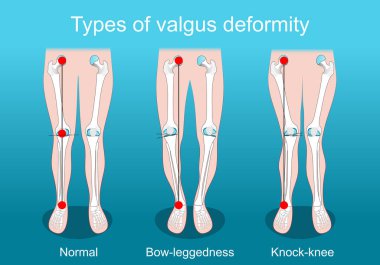 Valgus deformasyonları. Diz sakatlığı. Sağlıklı eklem, diz kırma ve boyun eğme. İnsan bacakları, kemikleri ve eklemleri. Düzeltici ameliyat. Vektör posteri. Isometric Düz İllüstrasyon.