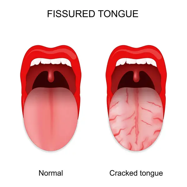 Fissured Tongue Healthy Cracked Tongue Oral Cavity Anomalies Vector Illustration — Stock Vector