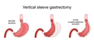 Dikey Kollu Gastrectomy. Cerrahi bir kilo verme işleminden önce ve sonra mide. Bariatrik ameliyat. Obezite tedavisi. İnsan midesinde enine kesit. Vektör illüstrasyonu