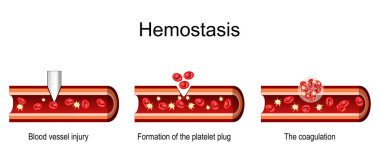 Hemostasis. Yaralanmadan sonra kan damarlarının kesilmesi trombosit tıkanması, pıhtılaşma ve yaraların iyileşmesi. Vektör illüstrasyonu